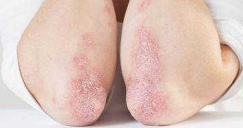 Schwangerschaft und Psoriasis: Herausforderung und Behandlungsoptionen für Frauen Schwangerschaft und Psoriasis: Herausforderung und Behandlungsoptionen für (Foto: AdobeStock 332799872 SNAB)